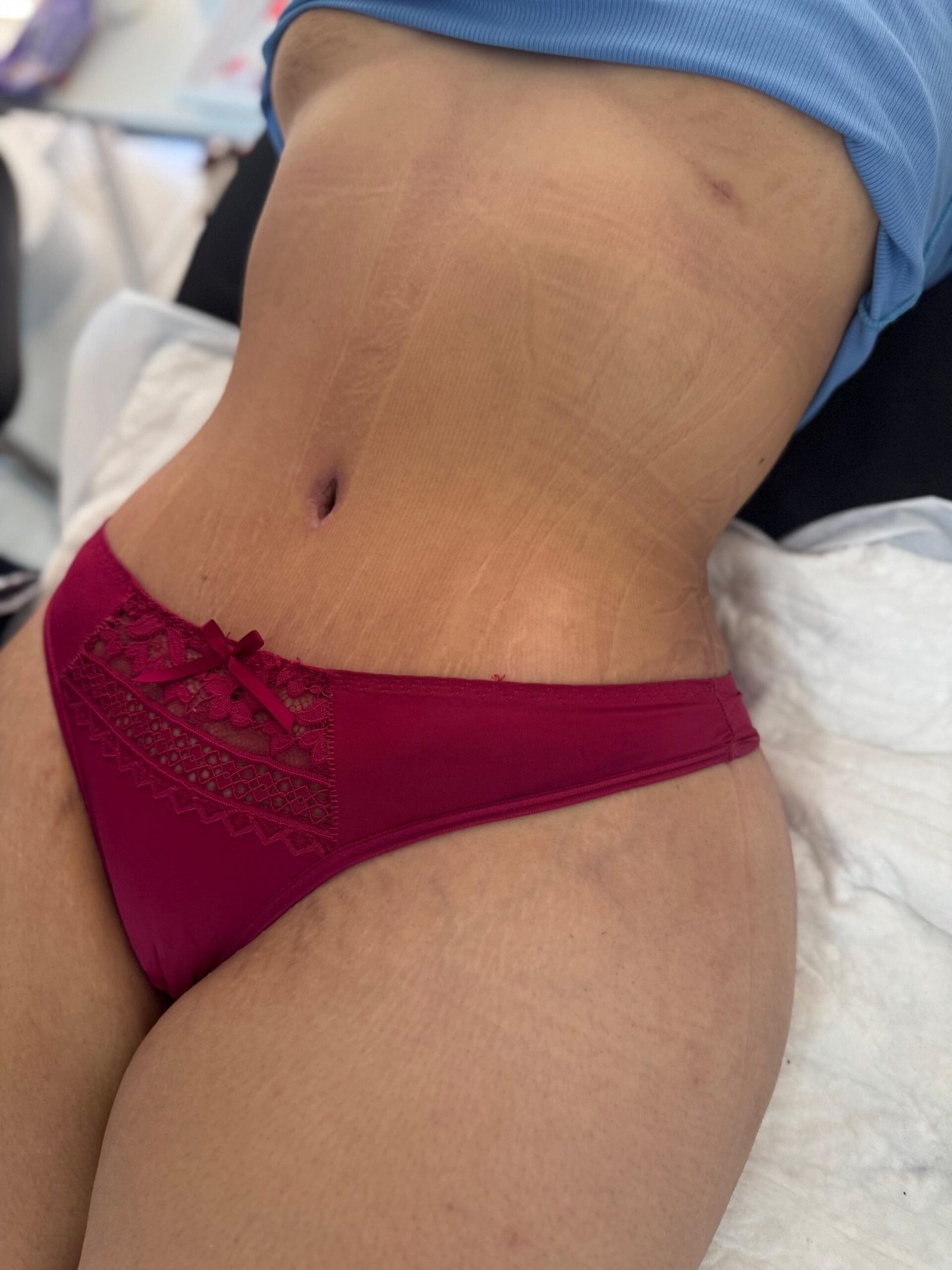 Lipoescultura Argentina. Dr Angel T. Carrascal. Cirujano Plastico en Argentina, Chile y Colombia (1)