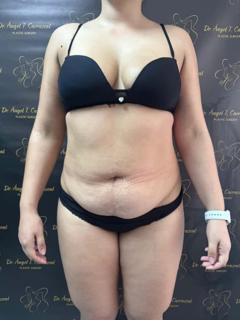 Lipoescultura Argentina. Dr Angel T. Carrascal. Cirujano Plastico en Argentina, Chile y Colombia (12)