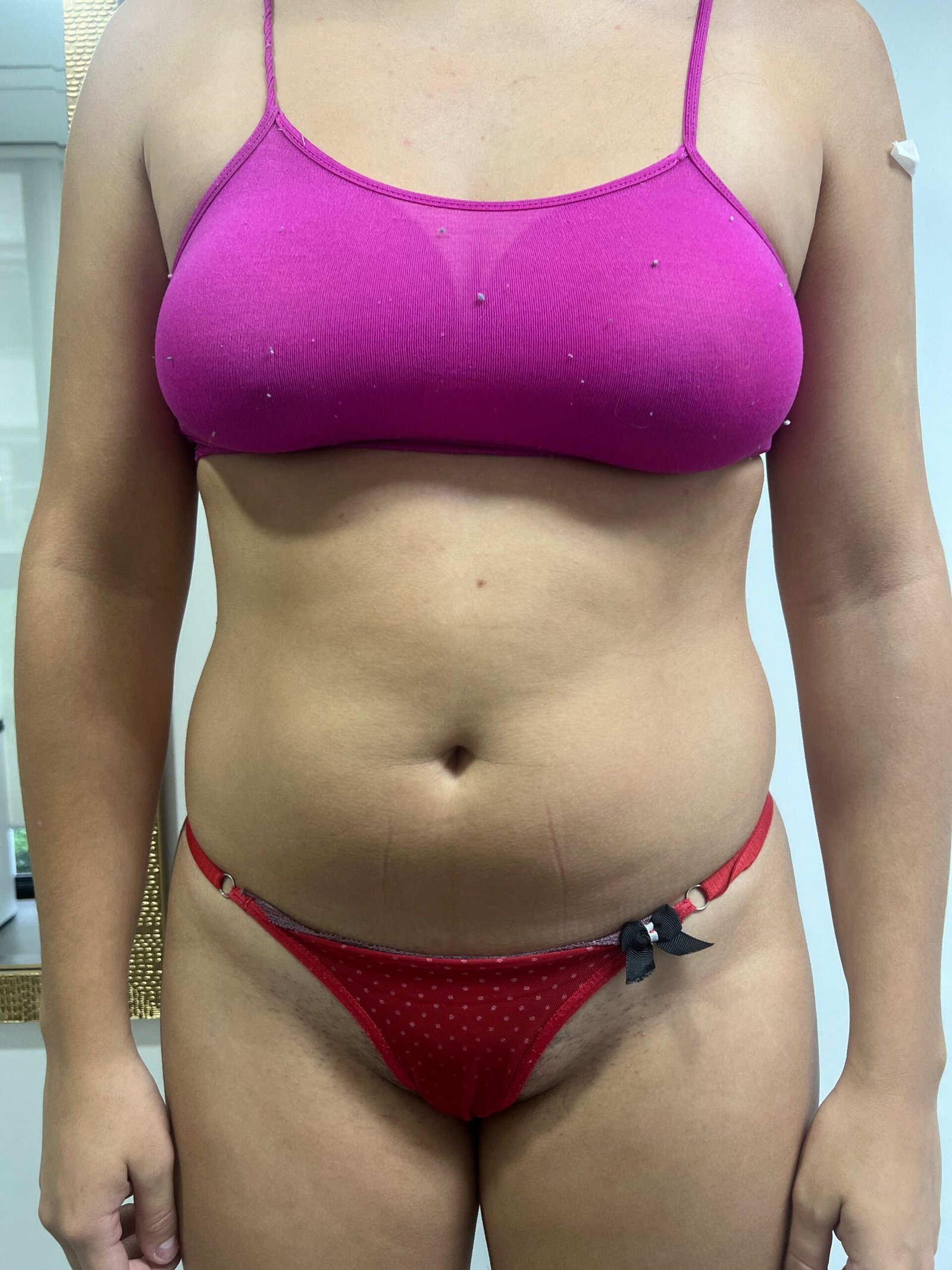 Lipoescultura Argentina. Dr Angel T. Carrascal. Cirujano Plastico en Argentina, Chile y Colombia (5)