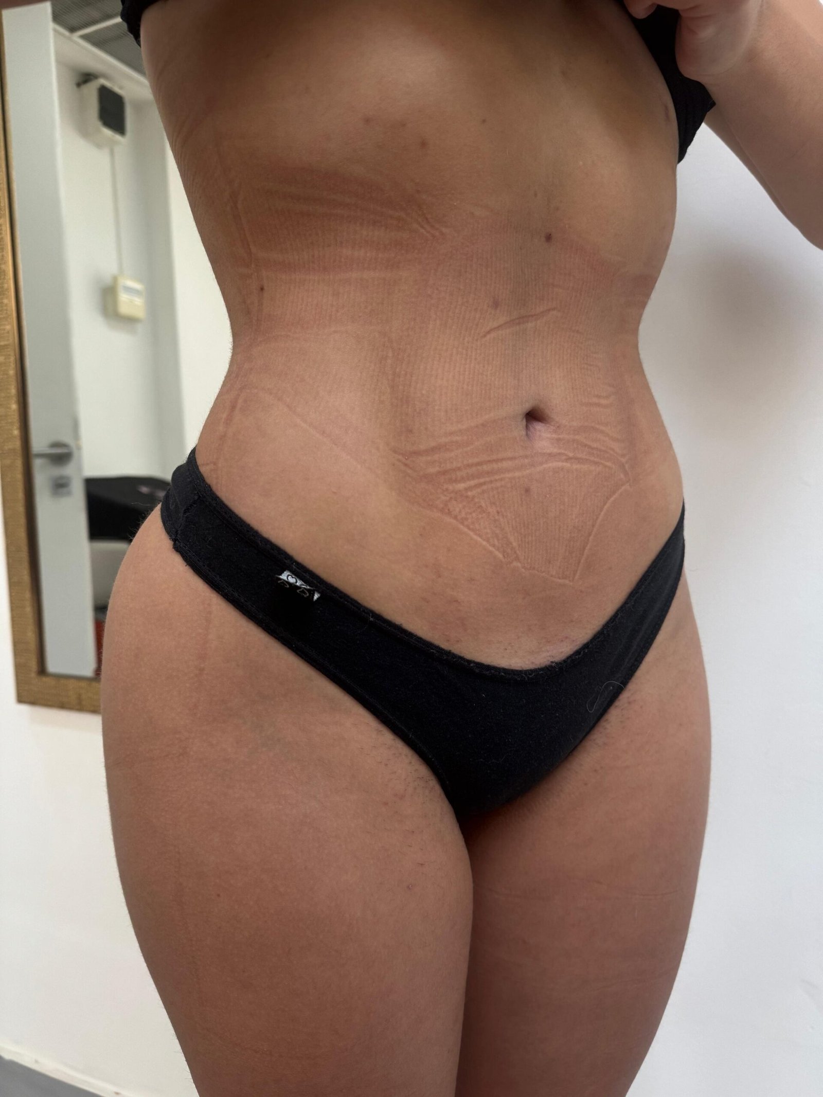 Lipoescultura Argentina. Dr Angel T. Carrascal. Cirujano Plastico en Argentina, Chile y Colombia (7)